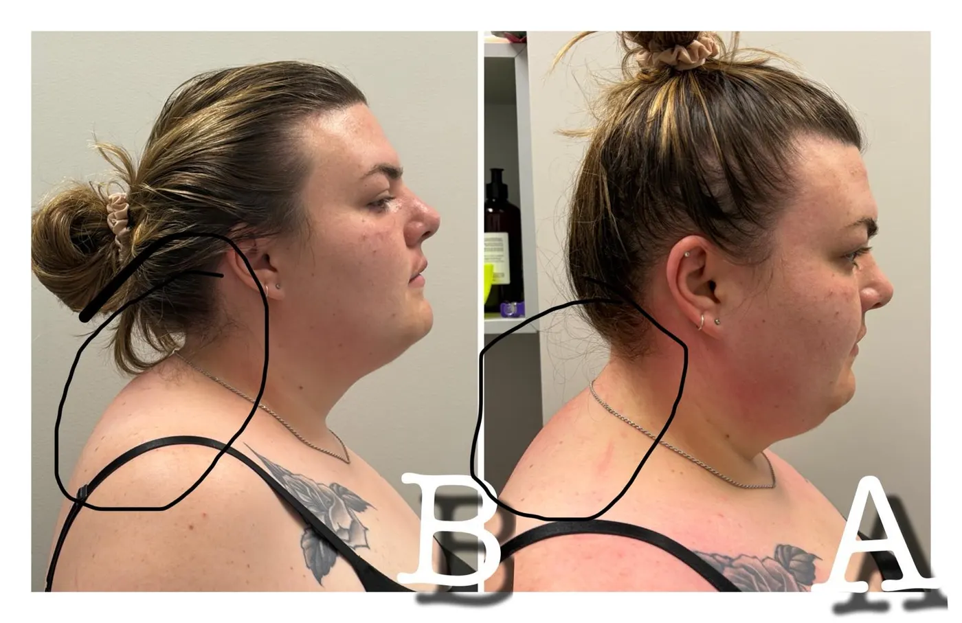 Before and after one hands-on neck hump session: the bump at the base of the neck is visibly smaller in profile