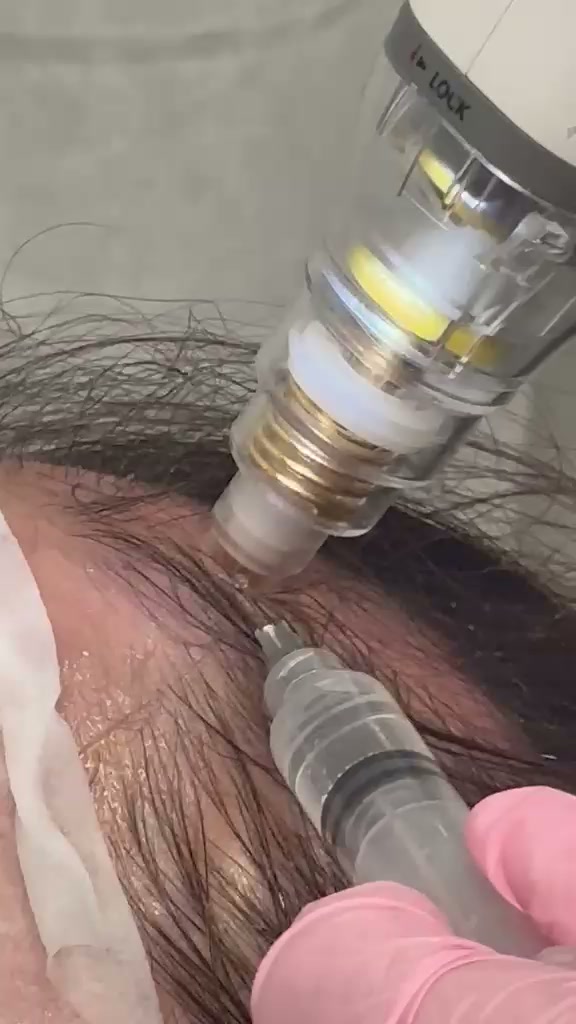 Exosome hair loss treatment with Potenza RF Fusion tip — real session at our clinic