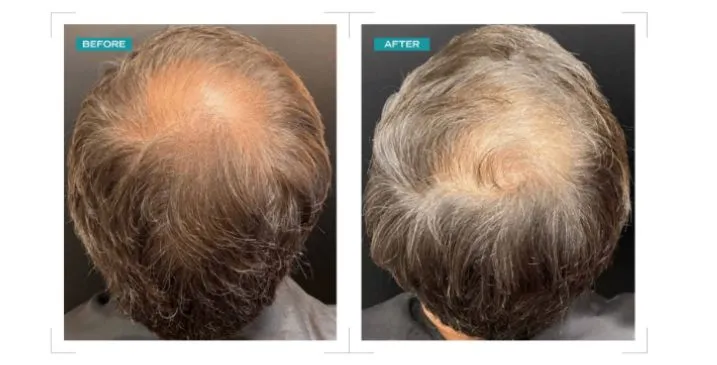 Hair density at the crown before and after treatment.