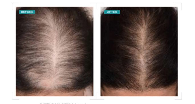 Female hair thinning treatment — before and after Exosome treatment