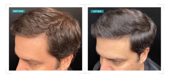 Male frontal hairline regrowth — before and after Exosome treatment