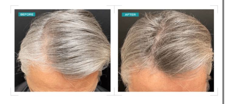 Grey hair thinning treatment — before and after