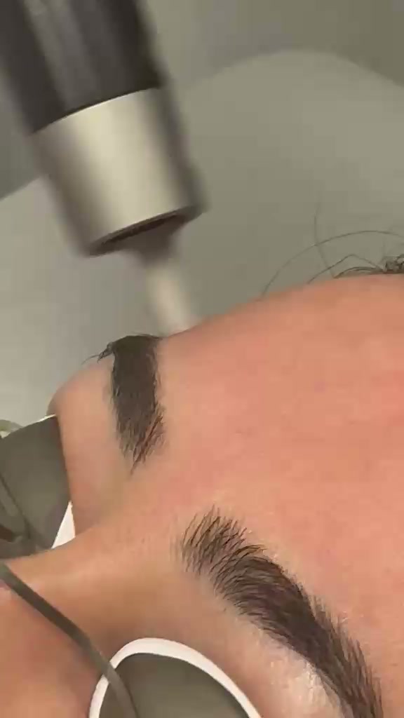 PicoSure laser pigmentation treatment — real session