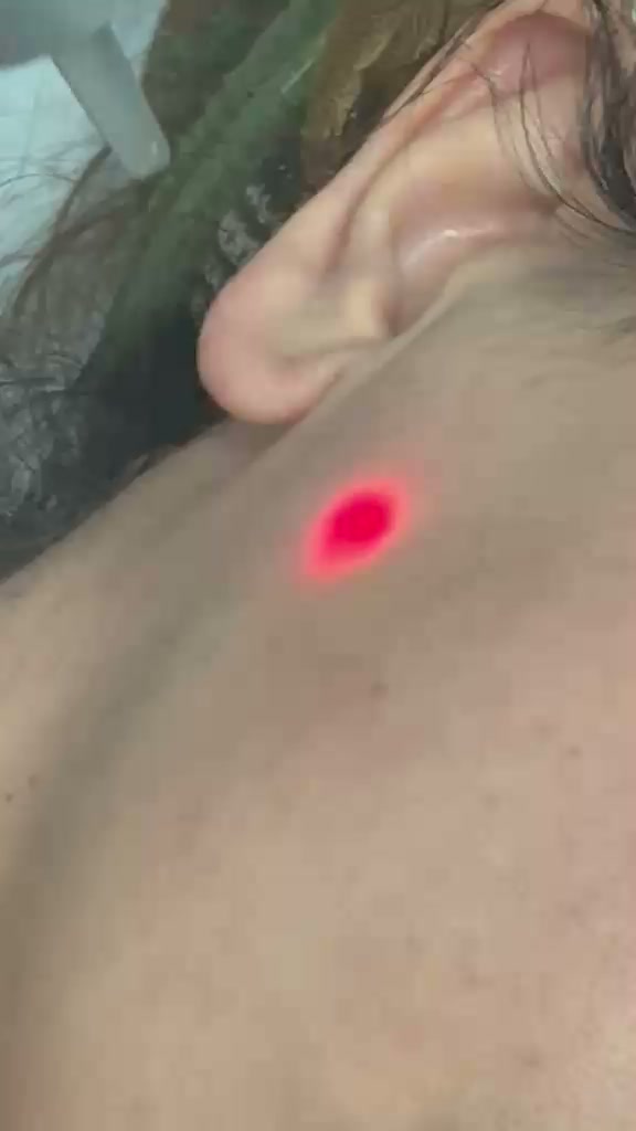 PicoSure laser skin rejuvenation — real session