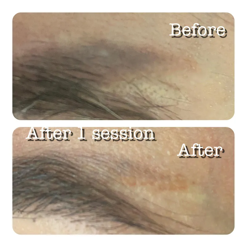 Pigmentation near the brow before and after PicoSure treatment.