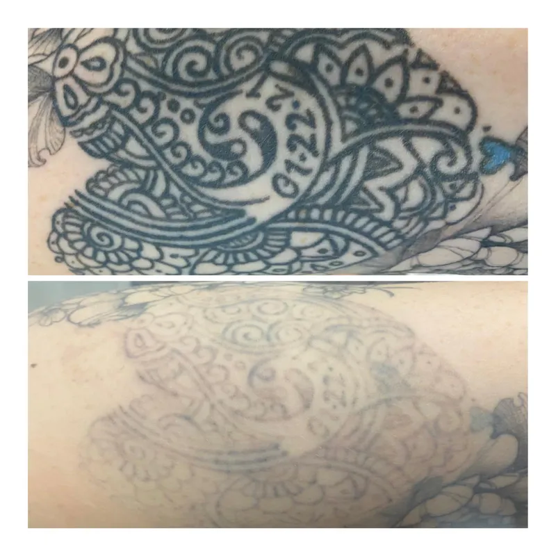 Mandala tattoo before and after PicoSure fading for a cover-up.