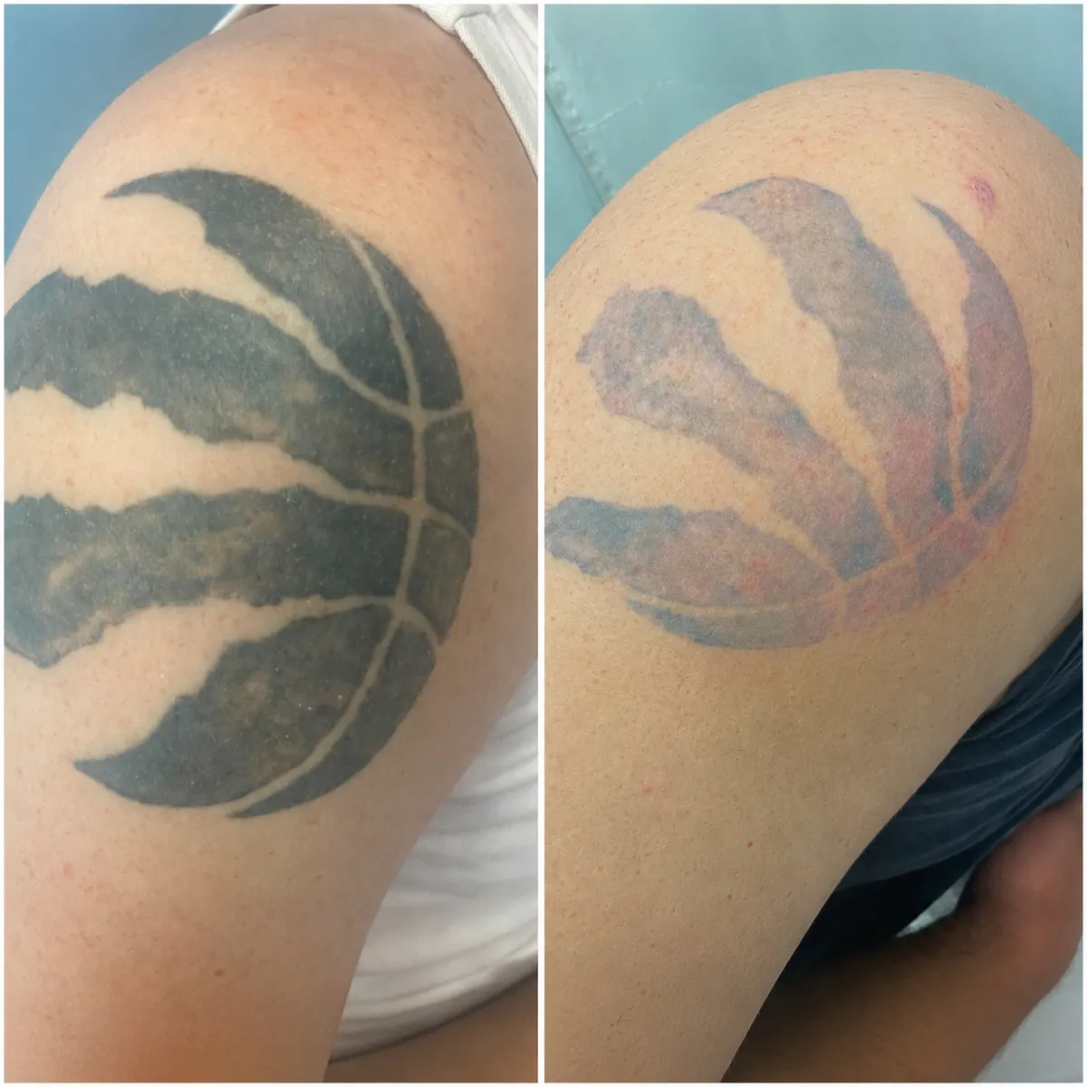 Raptors shoulder tattoo before and after PicoSure removal, near-complete clearance.