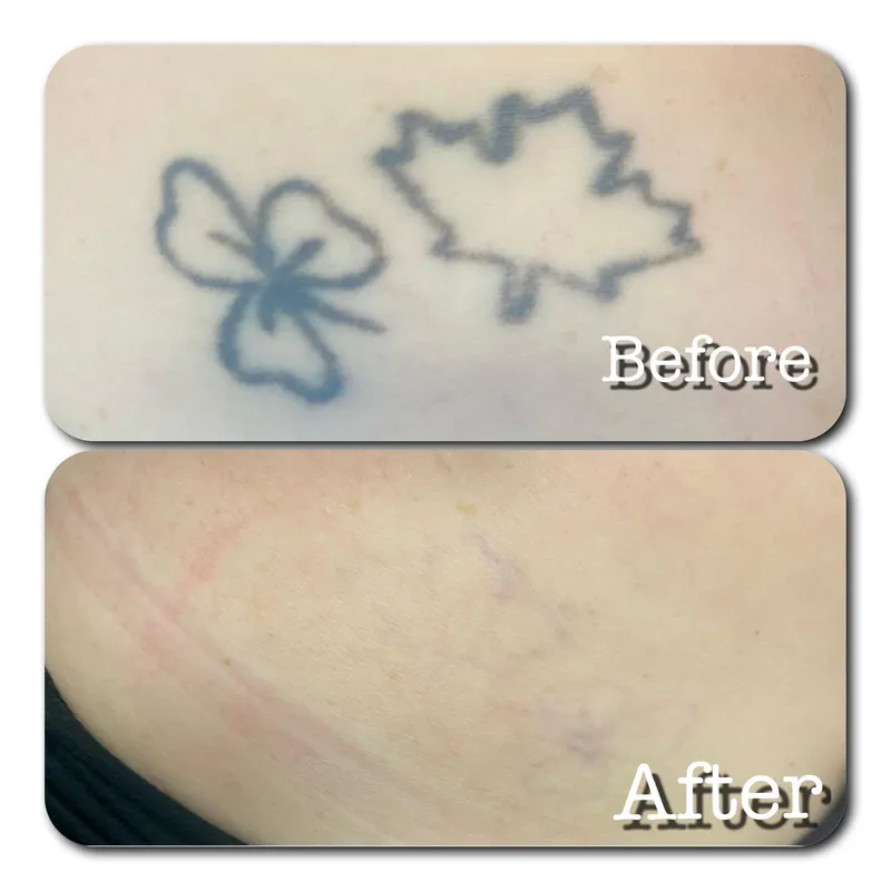 Green shamrock and maple leaf tattoo fully removed with 755 nm PicoSure.