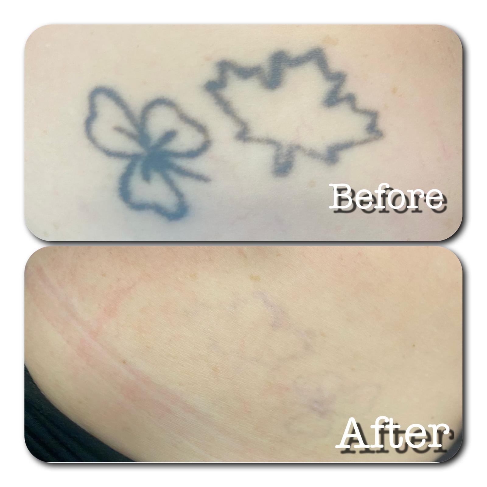 Green shamrock and maple leaf tattoo fully removed with 755nm PicoSure — before and after
