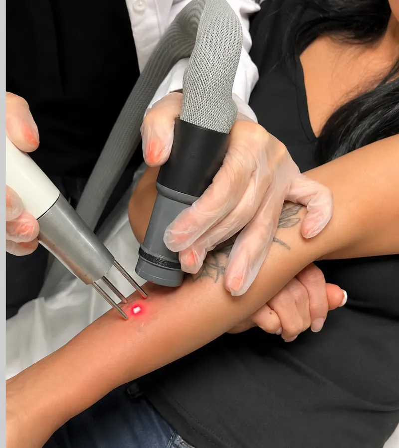 Tattoo Removal