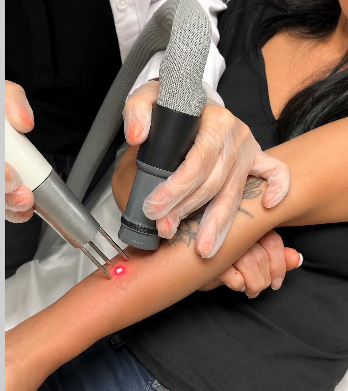 Tattoo Removal